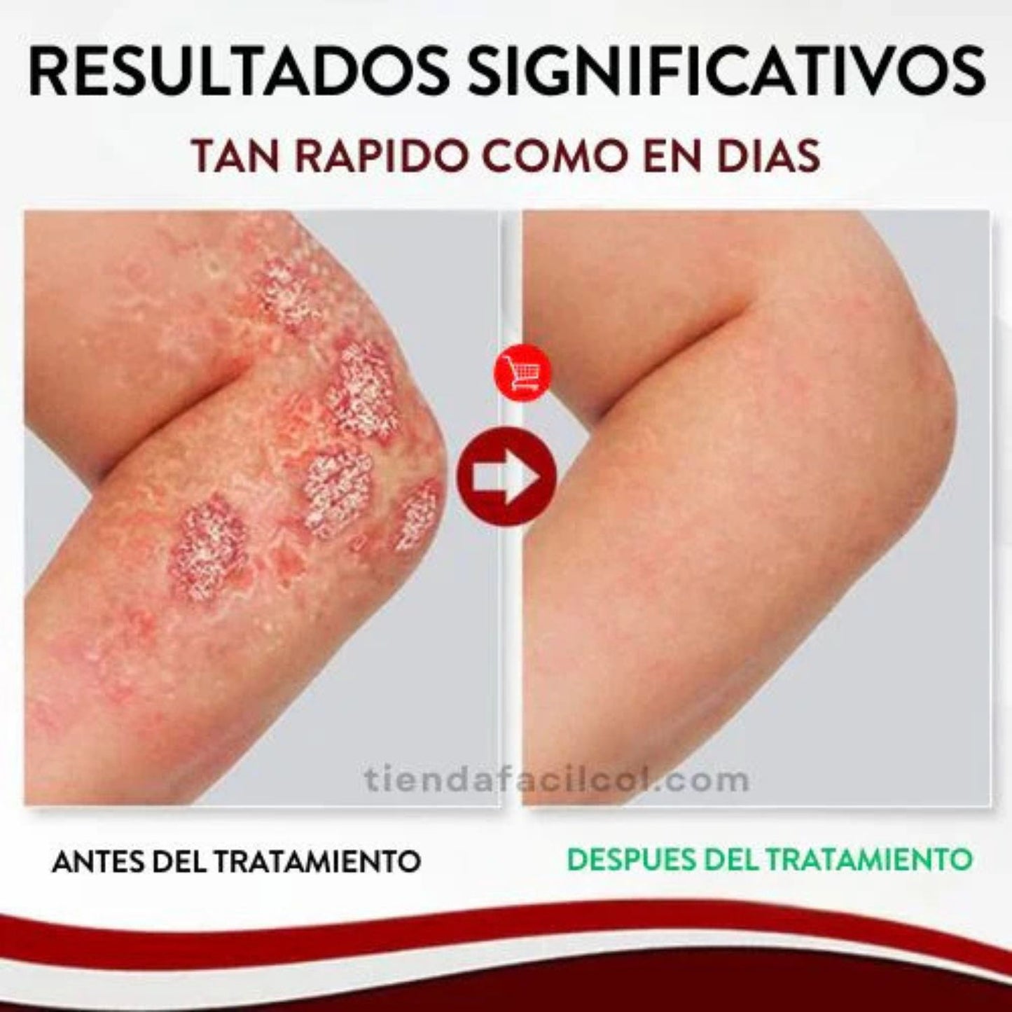 2x1 Spray Eliminación Psoriasis