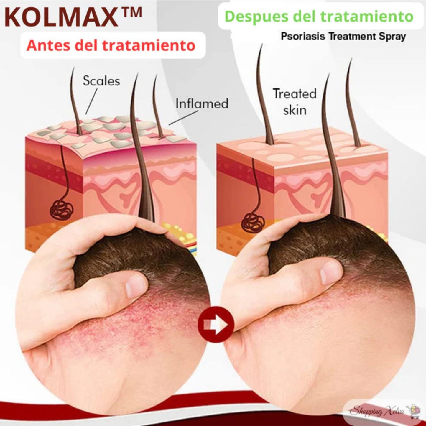 2x1 Spray Eliminación Psoriasis